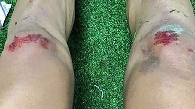 Yıldız futbolcunun dizleri bu hale geldi